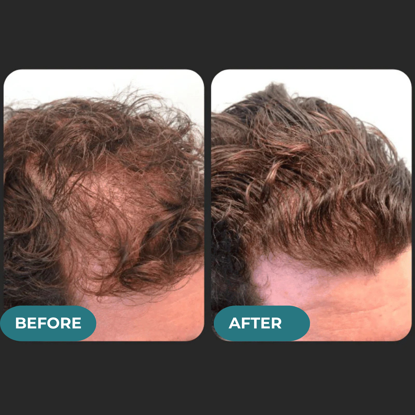 HAIRENCE™ Natural DHT Blocker