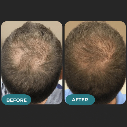 HAIRENCE™ Natural DHT Blocker