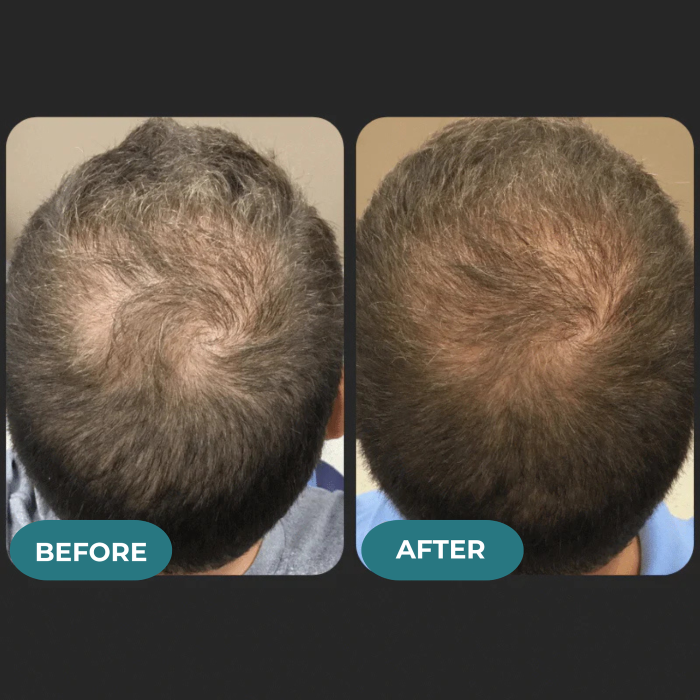 HAIRENCE™ Natural DHT Blocker